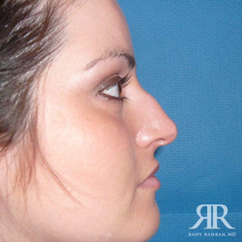 Female Rhinoplasty Before & After Gallery - Patient 323085 - Image 3
