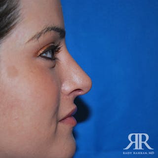 Female Rhinoplasty Before & After Gallery - Patient 323085 - Image 4