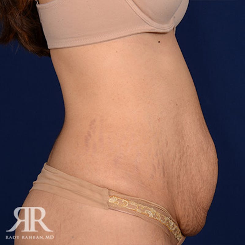 Tummy Tuck Before & After Gallery - Patient 257925 - Image 5