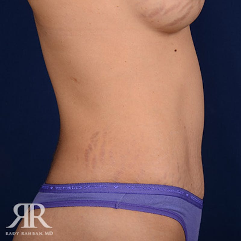 Tummy Tuck Before & After Gallery - Patient 257925 - Image 6