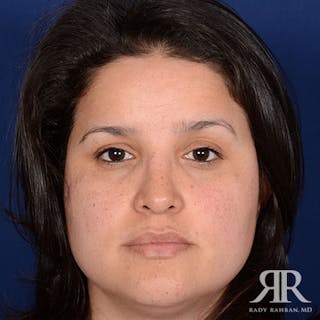 Female Rhinoplasty Before & After Gallery - Patient 169663 - Image 2