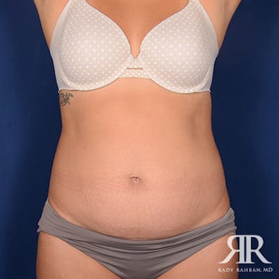 Tummy Tuck Before & After Gallery - Patient 229574 - Image 1