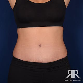 Tummy Tuck Before & After Gallery - Patient 229574 - Image 2