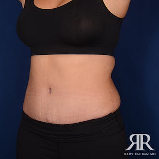 Tummy Tuck Before & After Gallery - Patient 229574 - Image 4