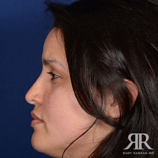 Female Rhinoplasty Before & After Gallery - Patient 169663 - Image 6