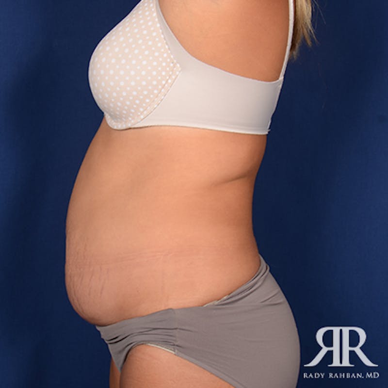 Tummy Tuck Before & After Gallery - Patient 229574 - Image 5
