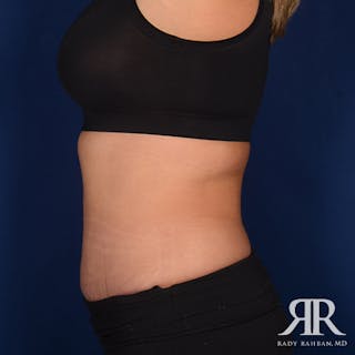 Tummy Tuck Before & After Gallery - Patient 229574 - Image 6