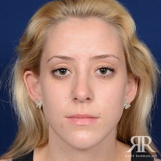 Female Rhinoplasty Before & After Gallery - Patient 155985 - Image 2