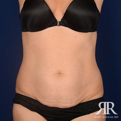 Tummy Tuck Before & After Gallery - Patient 439300 - Image 1