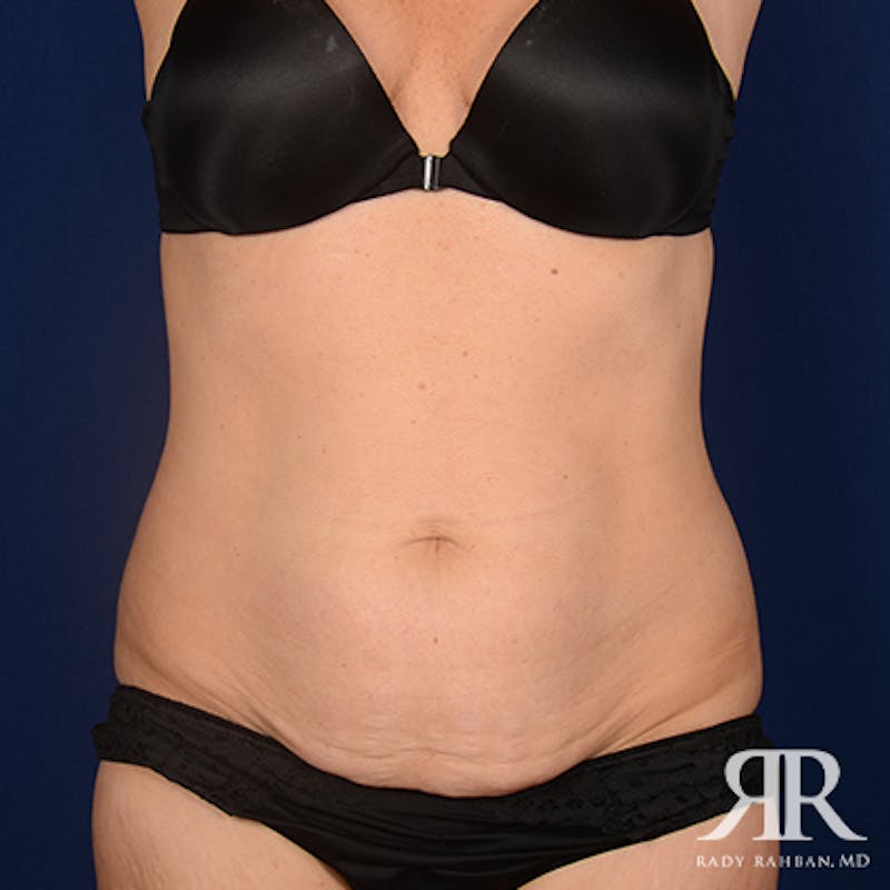 Tummy Tuck Before & After Gallery - Patient 439300 - Image 1