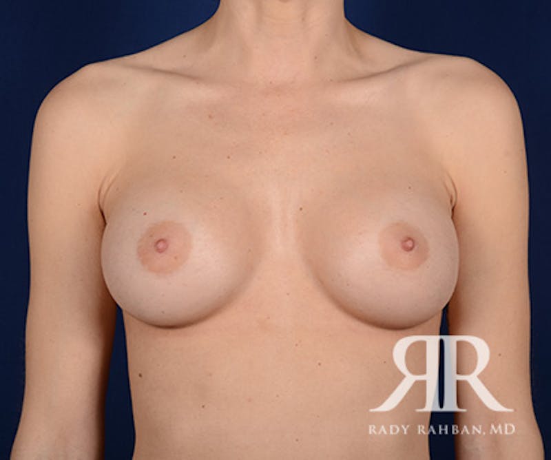 Breast Augmentation Before & After Gallery - Patient 185197 - Image 2