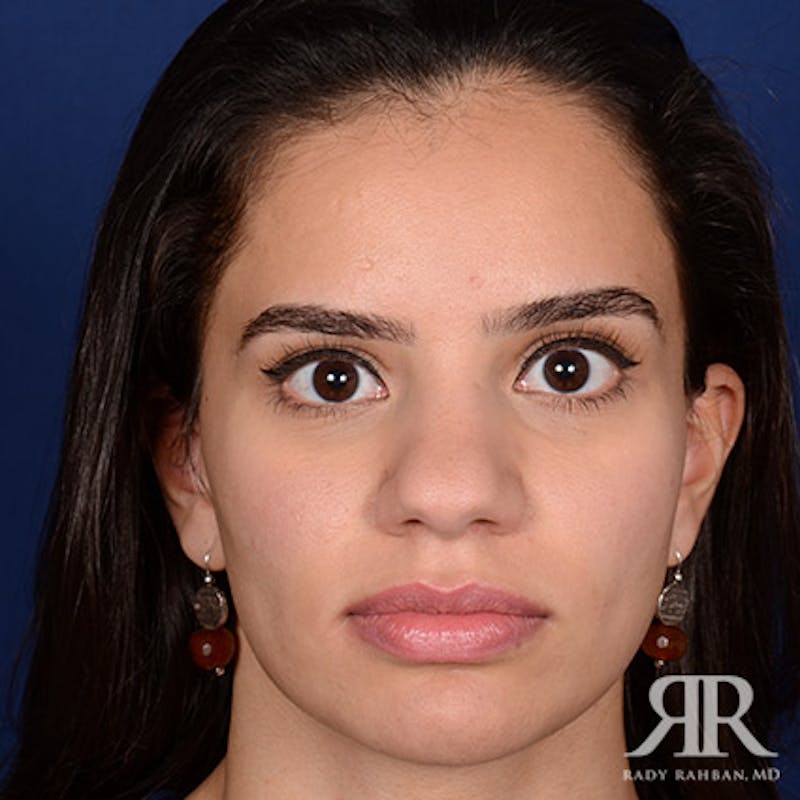Female Rhinoplasty Before & After Gallery - Patient 300027 - Image 1