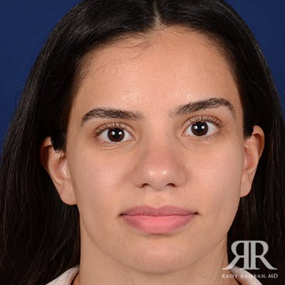 Female Rhinoplasty Before & After Gallery - Patient 300027 - Image 2
