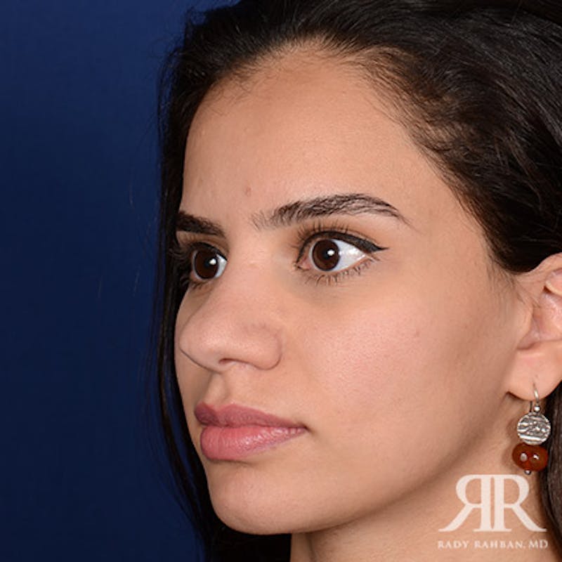 Female Rhinoplasty Before & After Gallery - Patient 300027 - Image 3