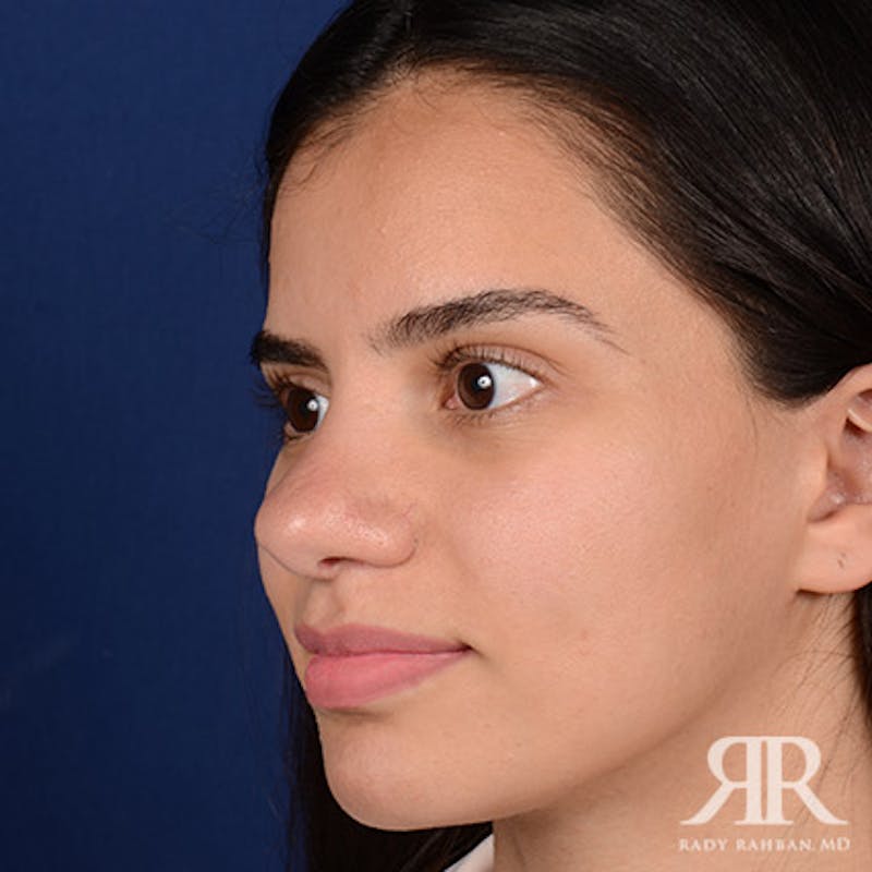 Female Rhinoplasty Before & After Gallery - Patient 300027 - Image 4
