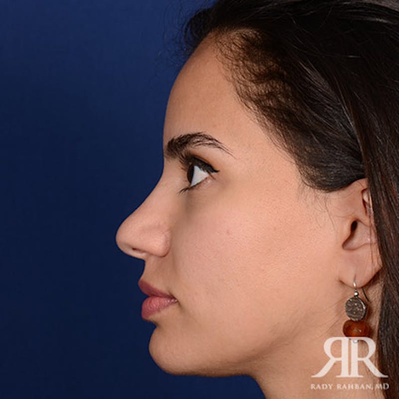 Female Rhinoplasty Before & After Gallery - Patient 300027 - Image 5