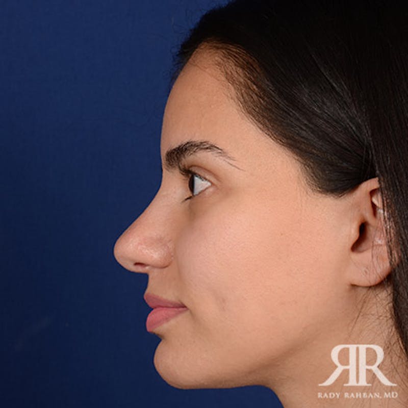 Female Rhinoplasty Before & After Gallery - Patient 300027 - Image 6