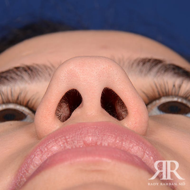 Female Rhinoplasty Before & After Gallery - Patient 300027 - Image 7