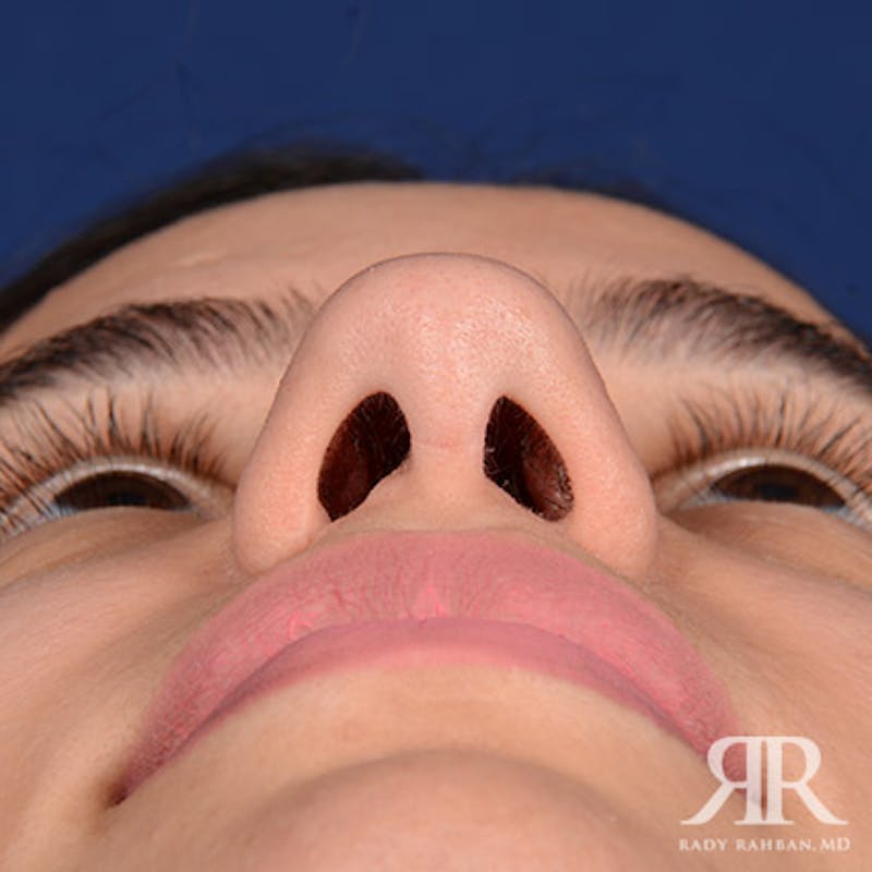 Female Rhinoplasty Before & After Gallery - Patient 300027 - Image 8