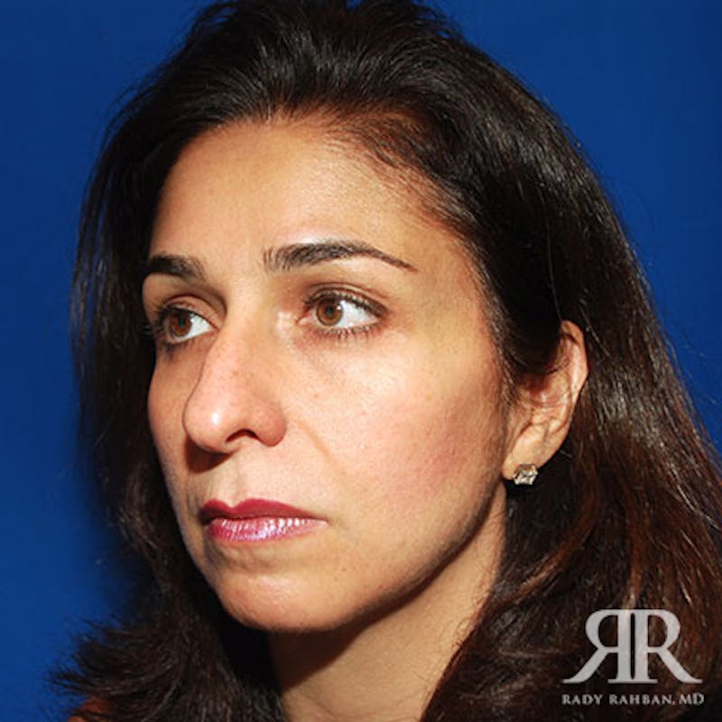 Female Rhinoplasty Before & After Gallery - Patient 153667 - Image 3