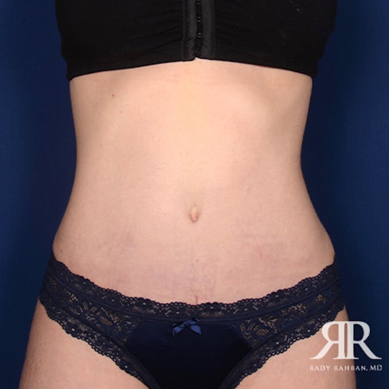 Tummy Tuck Before & After Gallery - Patient 360072 - Image 2