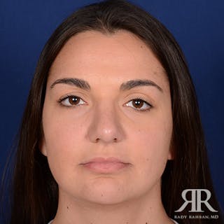 Female Rhinoplasty Before & After Gallery - Patient 225062 - Image 2