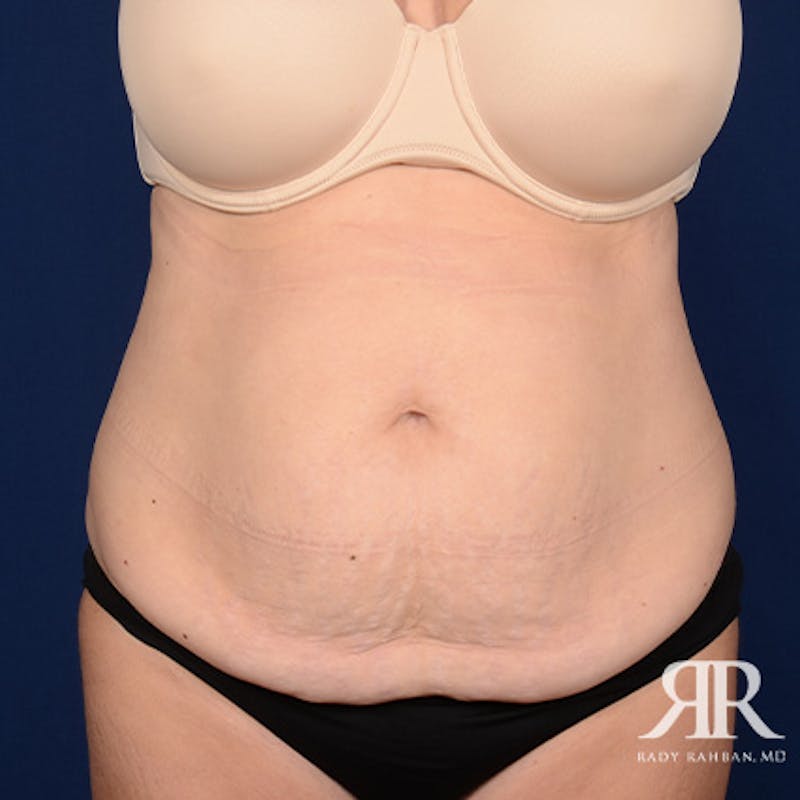 Tummy Tuck Before & After Gallery - Patient 450927 - Image 1