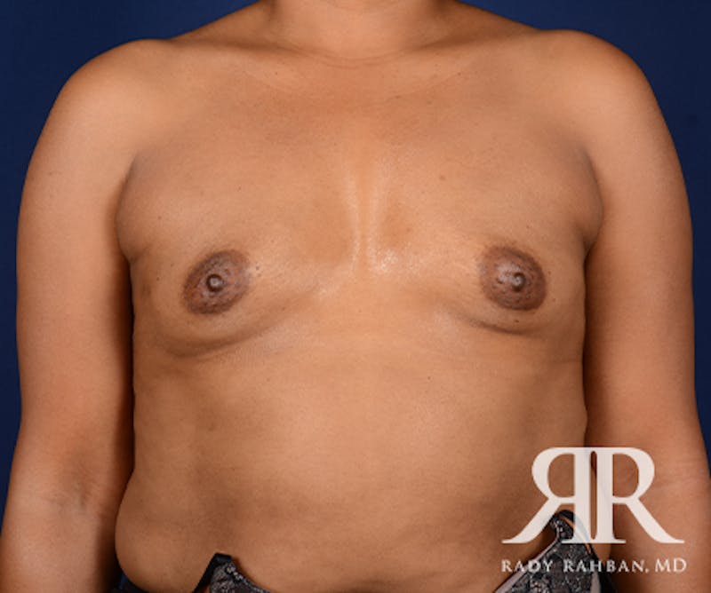 Breast Augmentation Before & After Gallery - Patient 372842 - Image 1