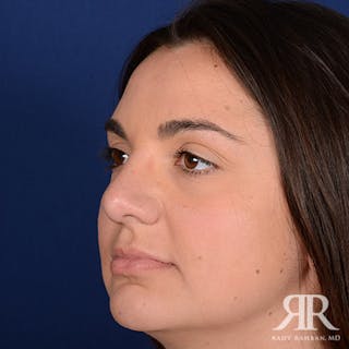 Female Rhinoplasty Before & After Gallery - Patient 225062 - Image 4