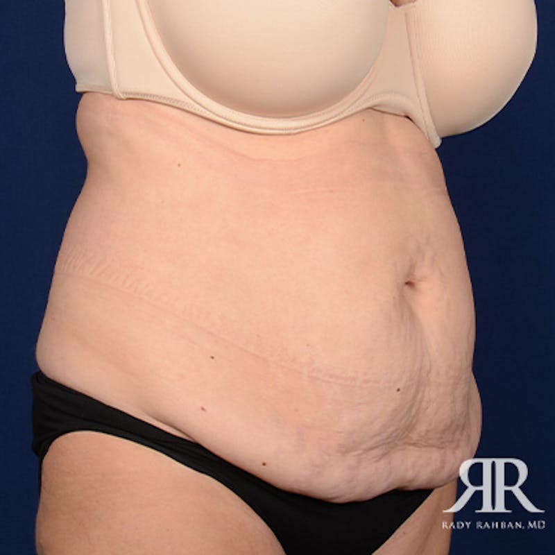 Tummy Tuck Before & After Gallery - Patient 450927 - Image 3