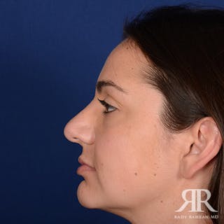Female Rhinoplasty Before & After Gallery - Patient 225062 - Image 6