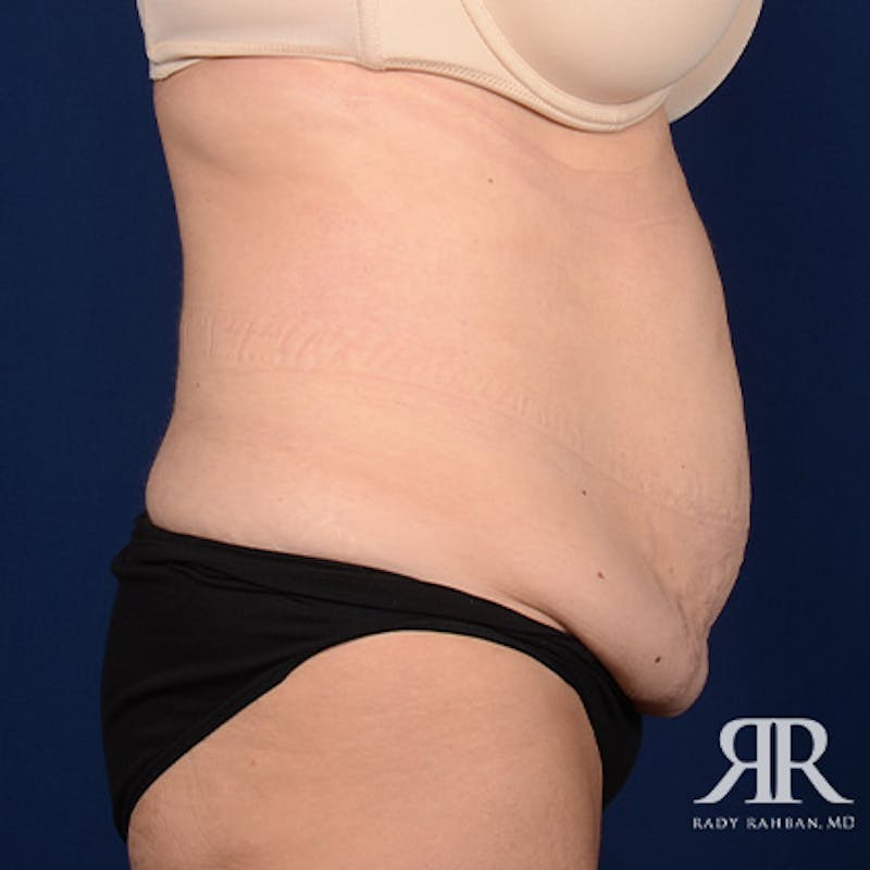 Tummy Tuck Before & After Gallery - Patient 450927 - Image 5