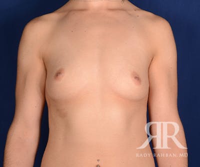 Breast Augmentation Before & After Gallery - Patient 252864 - Image 1
