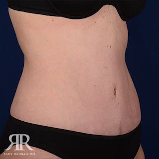 Tummy Tuck Before & After Gallery - Patient 429376 - Image 4