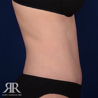 Tummy Tuck Before & After Gallery - Patient 429376 - Image 6