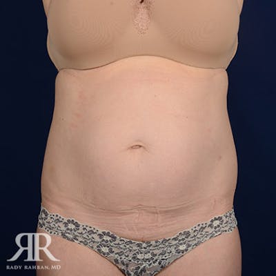 Tummy Tuck Before & After Gallery - Patient 103959 - Image 1