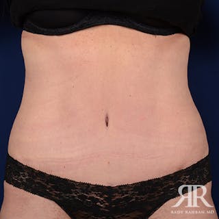 Tummy Tuck Before & After Gallery - Patient 342237 - Image 2