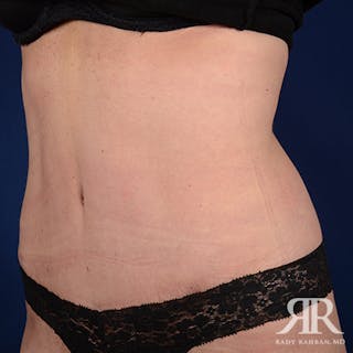 Tummy Tuck Before & After Gallery - Patient 342237 - Image 4