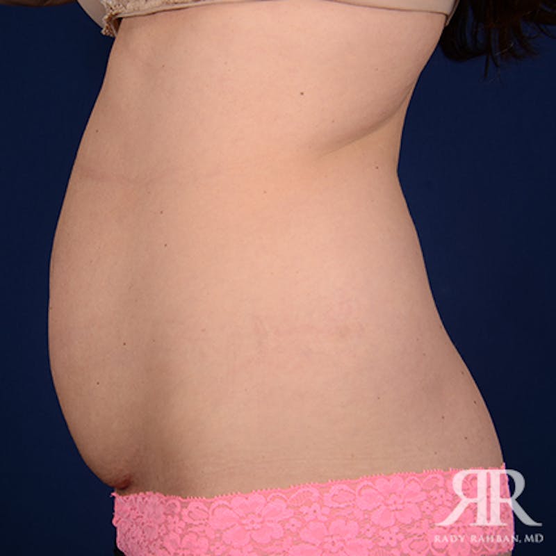 Tummy Tuck Before & After Gallery - Patient 342237 - Image 5