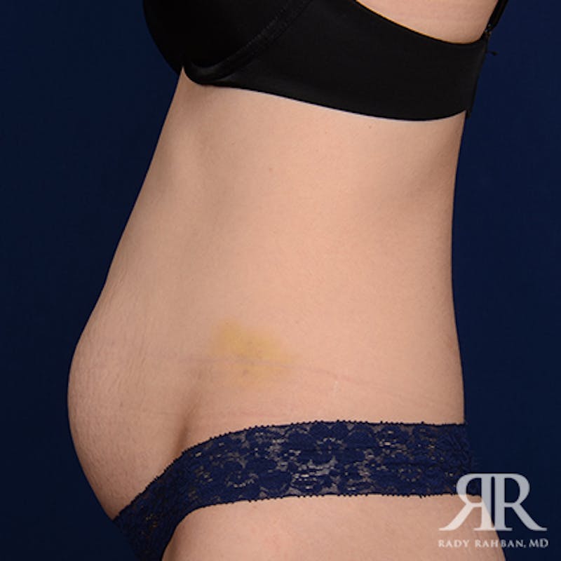 Tummy Tuck Before & After Gallery - Patient 323380 - Image 5