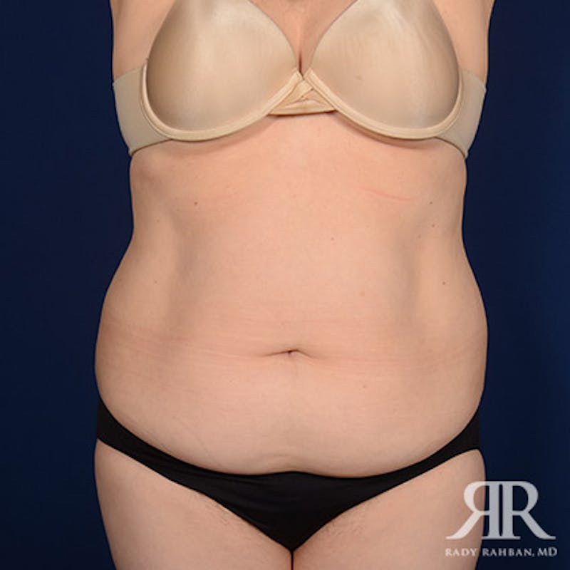 Tummy Tuck Before & After Gallery - Patient 115488 - Image 1