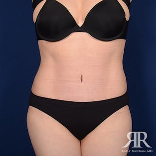 Tummy Tuck Before & After Gallery - Patient 115488 - Image 2