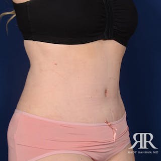 Tummy Tuck Before & After Gallery - Patient 243649 - Image 4