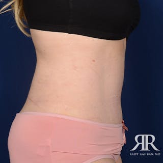 Tummy Tuck Before & After Gallery - Patient 243649 - Image 6
