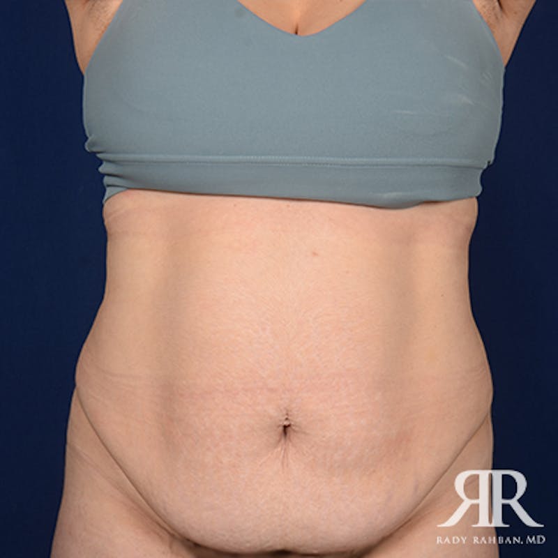 Tummy Tuck Before & After Gallery - Patient 122513 - Image 1