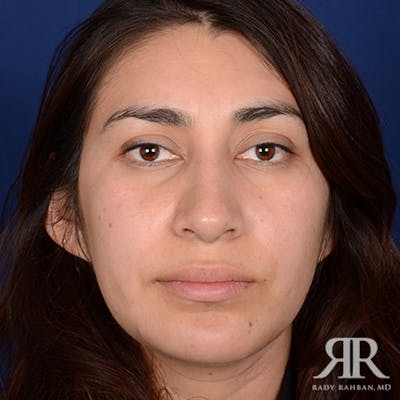 Female Rhinoplasty Before & After Gallery - Patient 154647 - Image 2