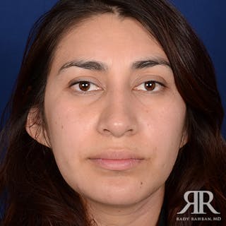Female Rhinoplasty Before & After Gallery - Patient 154647 - Image 2