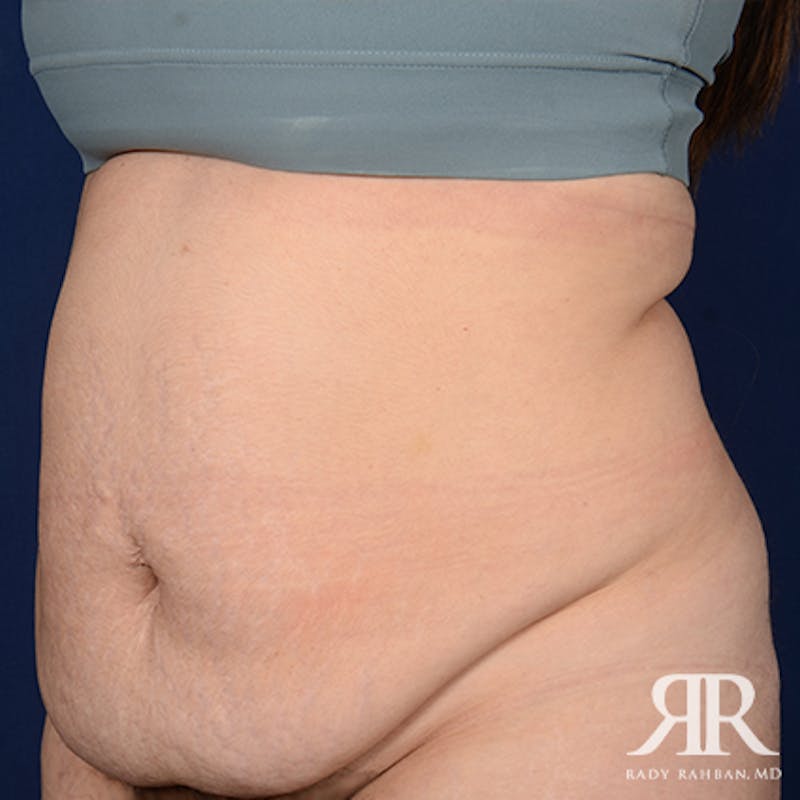 Tummy Tuck Before & After Gallery - Patient 122513 - Image 3