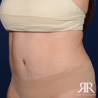 Tummy Tuck Before & After Gallery - Patient 122513 - Image 4