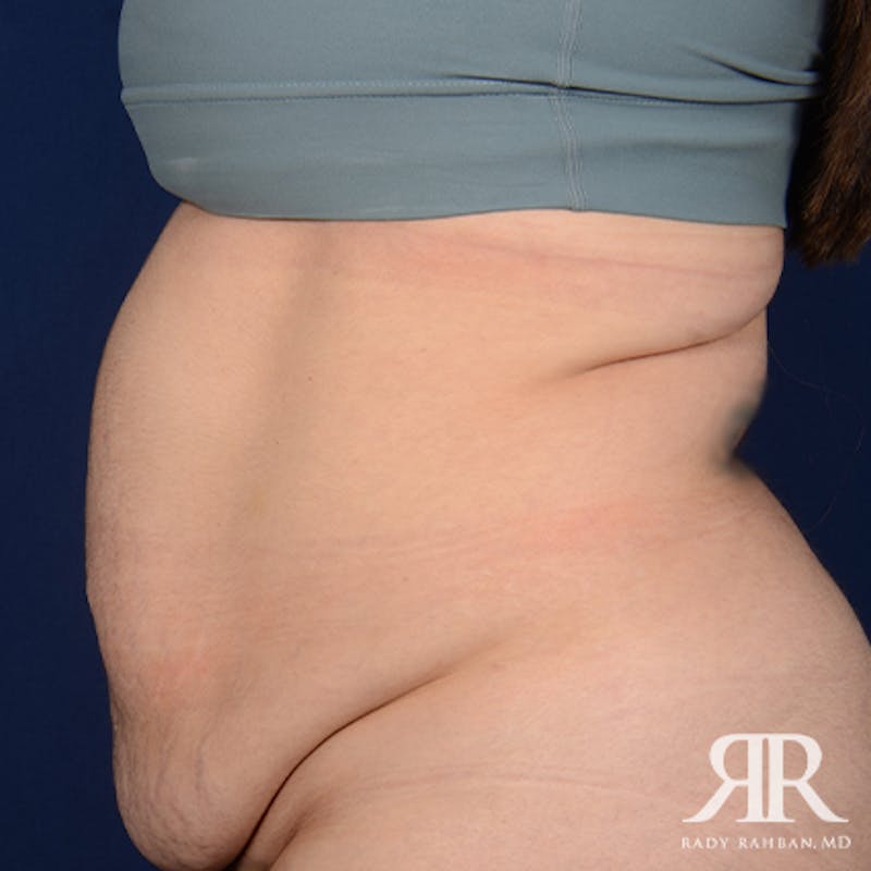 Tummy Tuck Before & After Gallery - Patient 122513 - Image 5